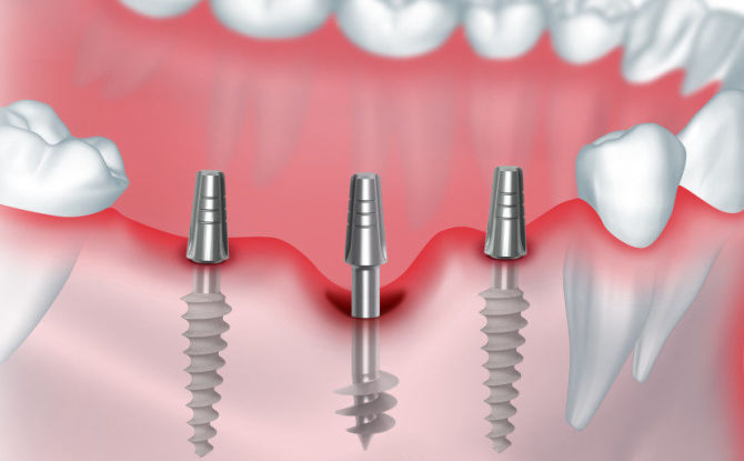 Implantation basale: qu'est-ce que c'est, les avantages et les inconvénients, les étapes de la pose de prothèses dentaires, les complications