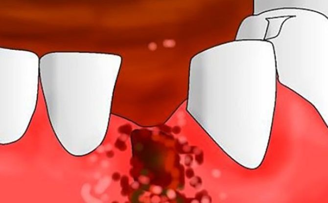 Alvéolite après extraction dentaire: symptômes, photos, traitement en clinique et à domicile