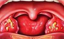 Jak rychle vyléčit hnisavou tonzilitu doma