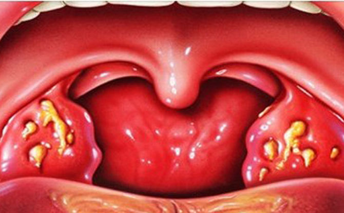 Paano mabilis na pagalingin ang purulent tonsilitis sa bahay