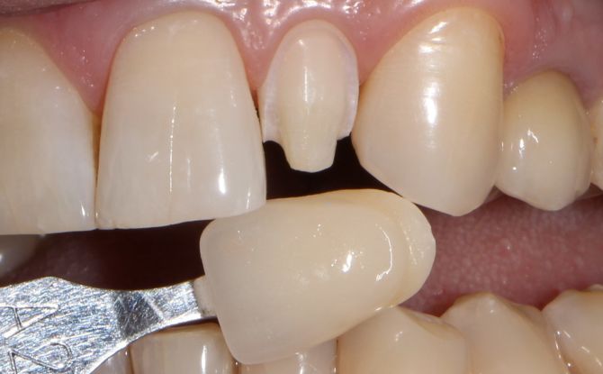 Extension des dents: comment construire, photo avant et après, avantages et inconvénients