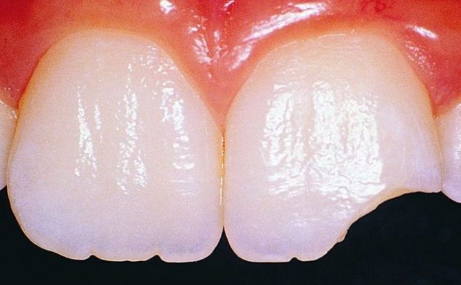 Raisons pour lesquelles les dents s'effritent et que faire à ce sujet