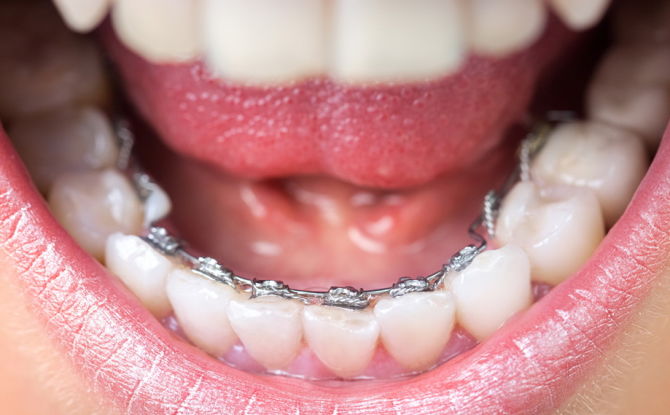 Lingual braces para sa pagwawasto ng kagat: kalamangan at kahinaan, pag-install, uri at gastos