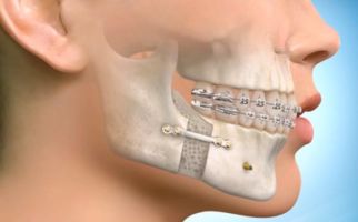 Fractures de la mâchoire inférieure et supérieure: classification, signes, symptômes et traitement