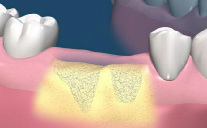 Prodloužení kostní tkáně před implantací zubu: podstata postupu, metody, fáze, náklady