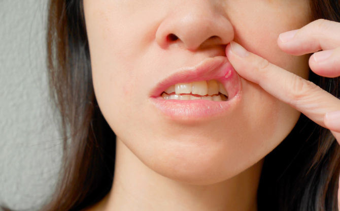 Treatment of stomatitis in the mouth in adults at home