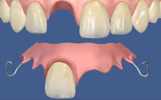 Types de fausses dents, quelles dents sont mieux à insérer