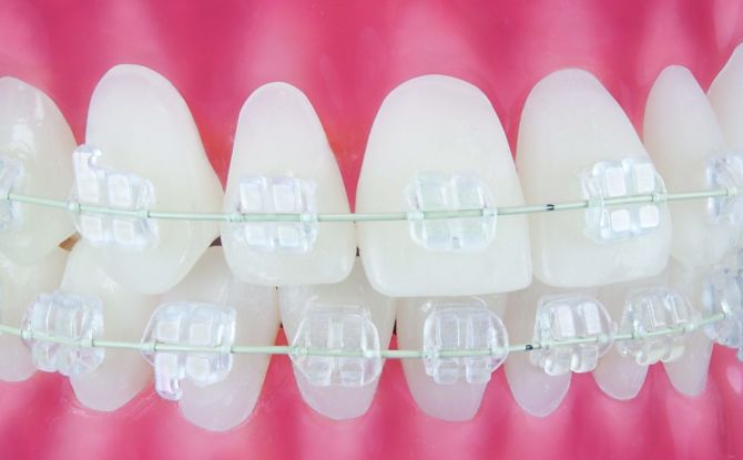 Sapphire braces: kalamangan, kawalan, pag-install, larawan bago at pagkatapos