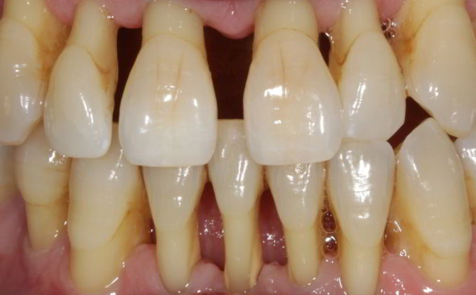 Paano makatipid ng ngipin sa panahon ng sakit na periodontal: katutubong remedyo at gamot, paggamot sa halamang-singaw