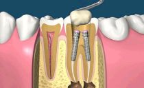 Une épingle dans une dent: qu'est-ce que c'est, comment sont-ils mis, types, coût