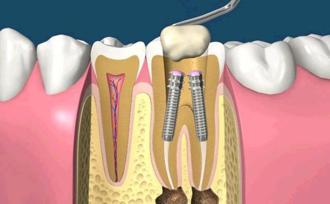 Une épingle dans une dent: qu'est-ce que c'est, comment sont-ils mis, types, coût