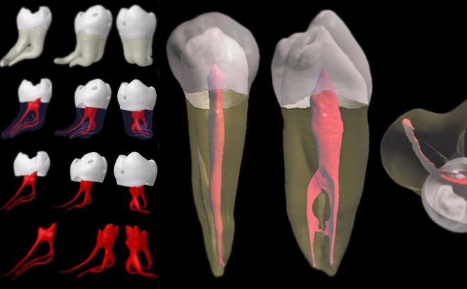 Ablation du nerf dentaire: comment et dans quels cas l'ablation est-elle effectuée, les conséquences