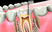 Po odstranění nervu a naplnění kanálků bolí zub: proč a co dělat