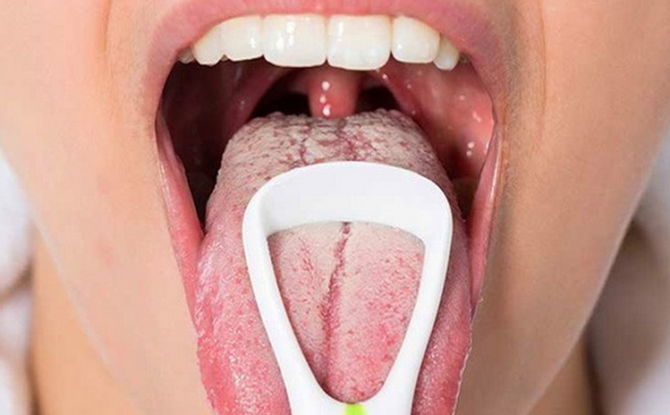 Candidiasis stomatitis: sanhi, sintomas, gamot at alternatibong paggamot