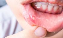 Stomatitis: sintomas, sanhi, paggamot at pag-iwas