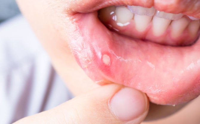 Stomatitis: sintomas, sanhi, paggamot at pag-iwas