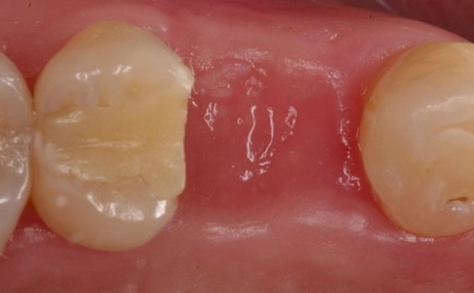 Puti na plaka sa butas pagkatapos ng pagkuha ng ngipin: mga larawan, sanhi at paggamot