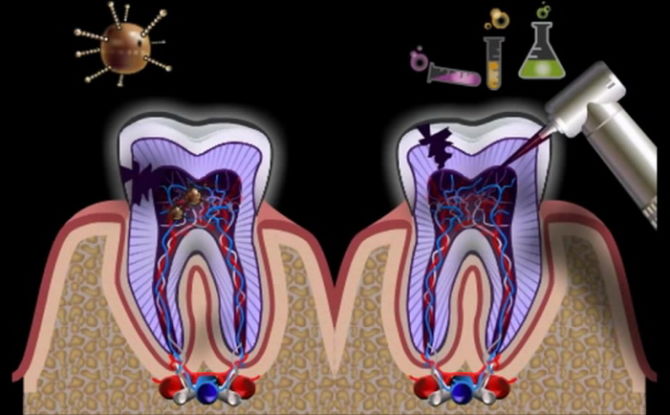 Pamamaga ng ugat ng mga kanal ng ngipin at ngipin: mga palatandaan, sintomas at paggamot