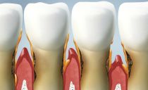 Mga sanhi, sintomas at paggamot ng periodontitis