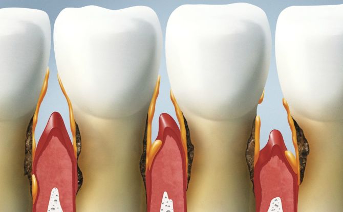 Mga sanhi, sintomas at paggamot ng periodontitis