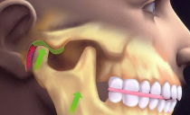Luxation de la mâchoire inférieure: symptômes, traitement, comment redresser la mâchoire à la maison