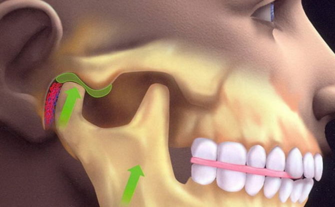Dislokace dolní čelisti: příznaky, léčba, jak narovnat čelist doma