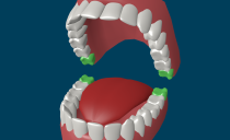 Dents de sagesse: structure, caractéristiques de croissance, indications de retrait