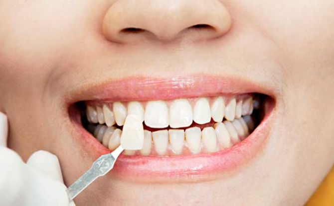 Que sont les facettes sur les dents: types, avantages et inconvénients