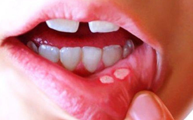 Causes, symptoms and treatment of aphthous stomatitis