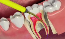 Ngipin pulpitis: kung paano pagalingin, pamamaraan at yugto ng paggamot, komplikasyon, pag-iwas