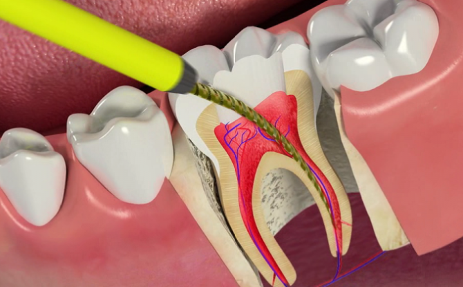 Ngipin pulpitis: kung paano pagalingin, pamamaraan at yugto ng paggamot, komplikasyon, pag-iwas