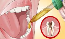 Comment traiter les dents malades à la maison et comment soulager les maux de dents aigus