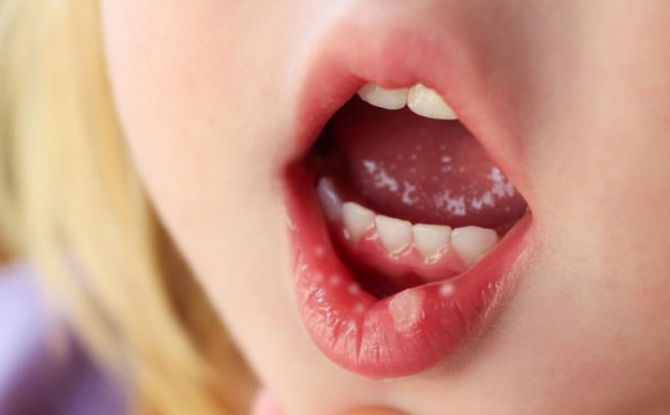 Herpes in the mouth in adults and children: how it looks and how to treat