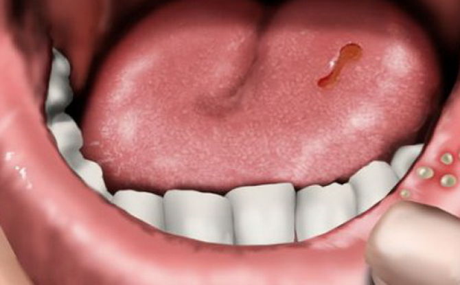 Stomatitis sa bibig sa mga may sapat na gulang: nangyayari man, kung paano at kung ano ang ituturing