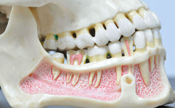 Osteomyelitida dolní a horní čelisti: příčiny, příznaky a léčba