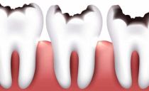 Classification des caries dentaires selon Black et le système OMS, en particulier la préparation des caries