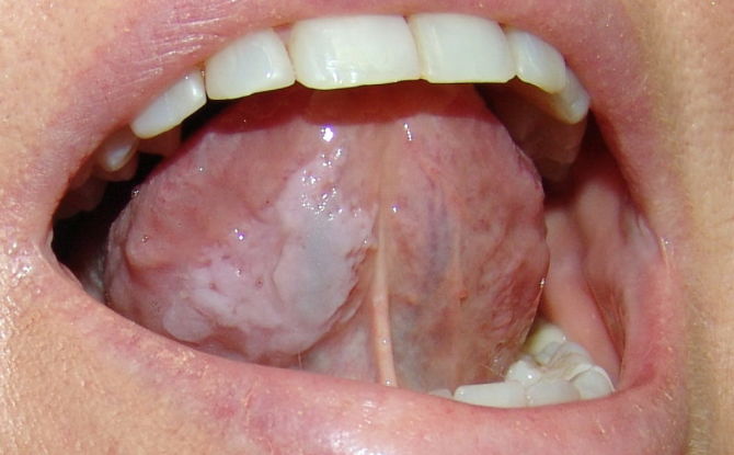 Ang Leukoplakia ng oral mucosa at dila: mga form, sanhi, sintomas, paggamot