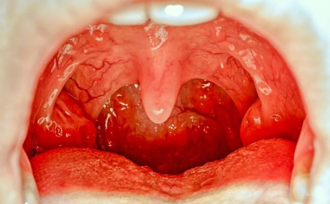 Inflammation des amygdales et des amygdales dans la gorge chez l'adulte et l'enfant: symptômes, causes, traitement, photo