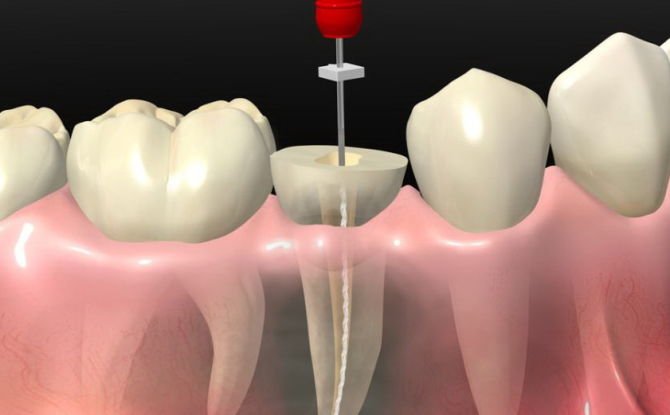 Qu'est-ce que la dépulpation des dents, méthodes de dépulpation avec prothèses