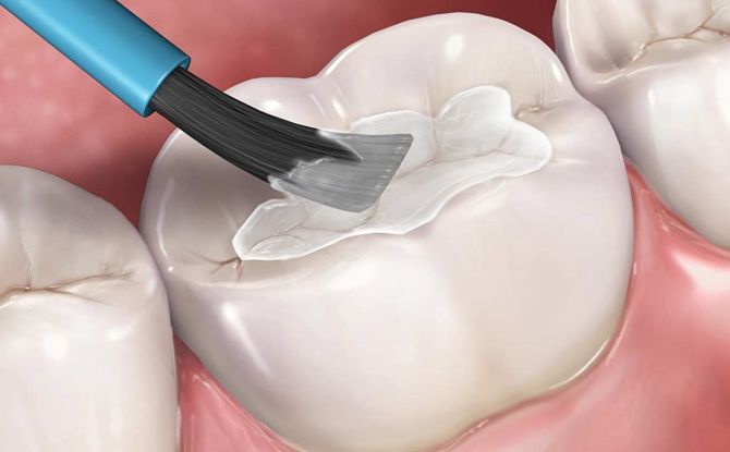 Sceller les fissures des dents chez les enfants et les adultes: quels sont ces avantages et inconvénients?