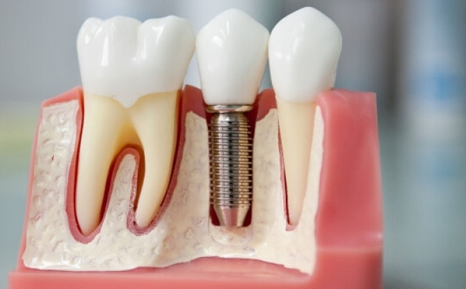 Implants dentaires: types, coût et installation