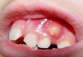 Gum abscess