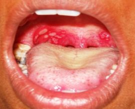 Aphthous stomatitis