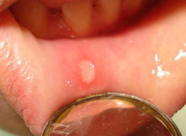 Aphthous stomatitis