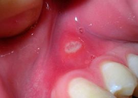 Aphthous stomatitis