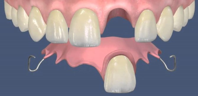 Isang ngipin acrylic prosthesis