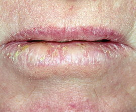 Actinic cheilitis