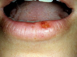 Actinic cheilitis