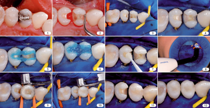 Algorithm para sa pag-install ng isang photopolymer seal