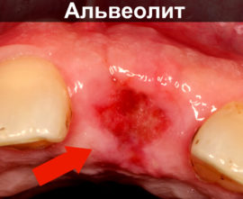 Alveolite